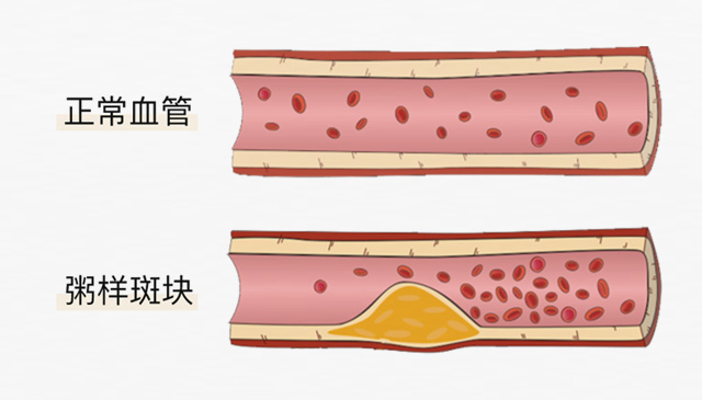 血栓是心梗、腦梗的元兇，很容易找上這些人