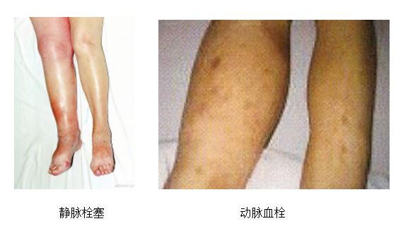 動(dòng)脈血栓和靜脈血栓有什么區(qū)別嗎？