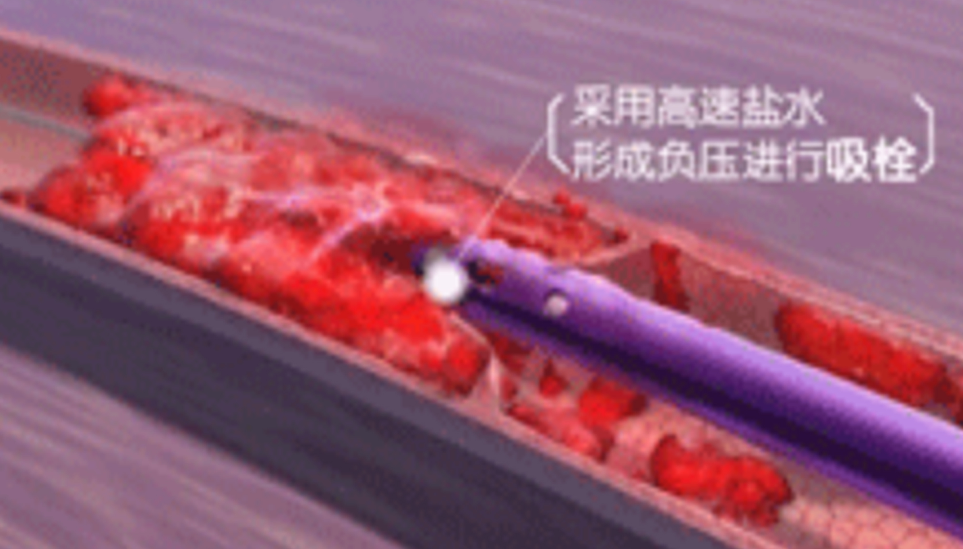 深靜脈血栓能致命，防治“大法”要了解！