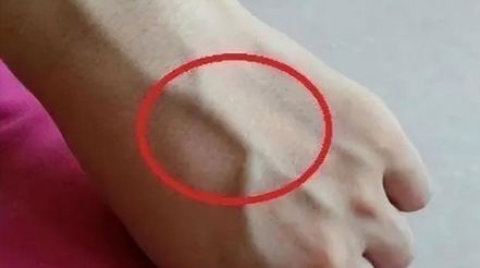 有人手臂上“青筋暴起”，有人卻看不到“青筋”，這是咋回事？