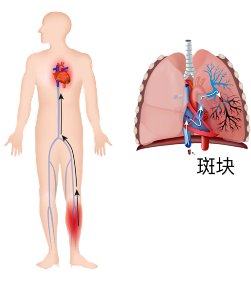 血栓是心梗、腦梗的元兇，很容易找上這些人