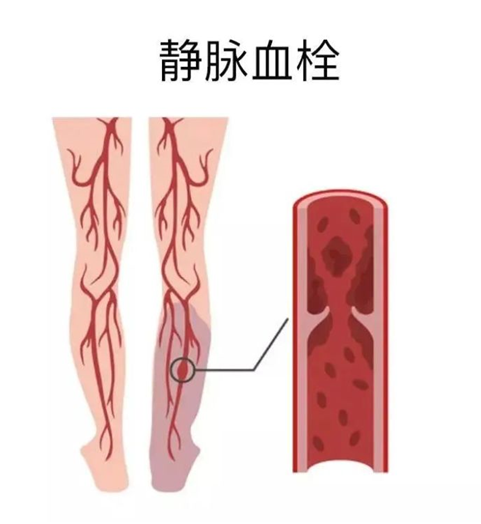 血栓是心梗、腦梗的元兇，很容易找上這些人