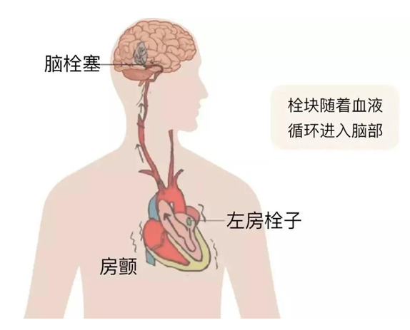 血栓是心梗、腦梗的元兇，很容易找上這些人