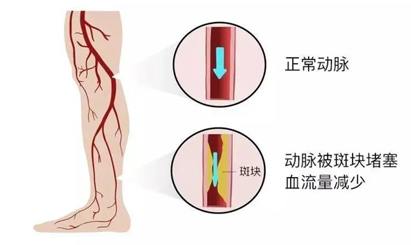 血栓是心梗、腦梗的元兇，很容易找上這些人