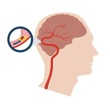 血栓是心梗、腦梗的元兇，很容易找上這些人
