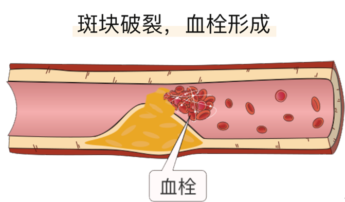血栓是心梗、腦梗的元兇，很容易找上這些人