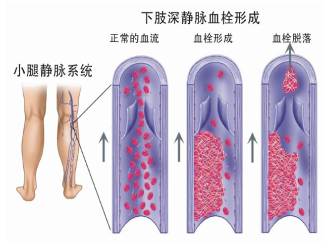 警惕！這個(gè)全球“第三大心血管殺手”，我們?cè)撊绾螒?yīng)對(duì)？