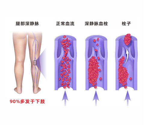 深靜脈血栓類似病癥的認識與區(qū)分