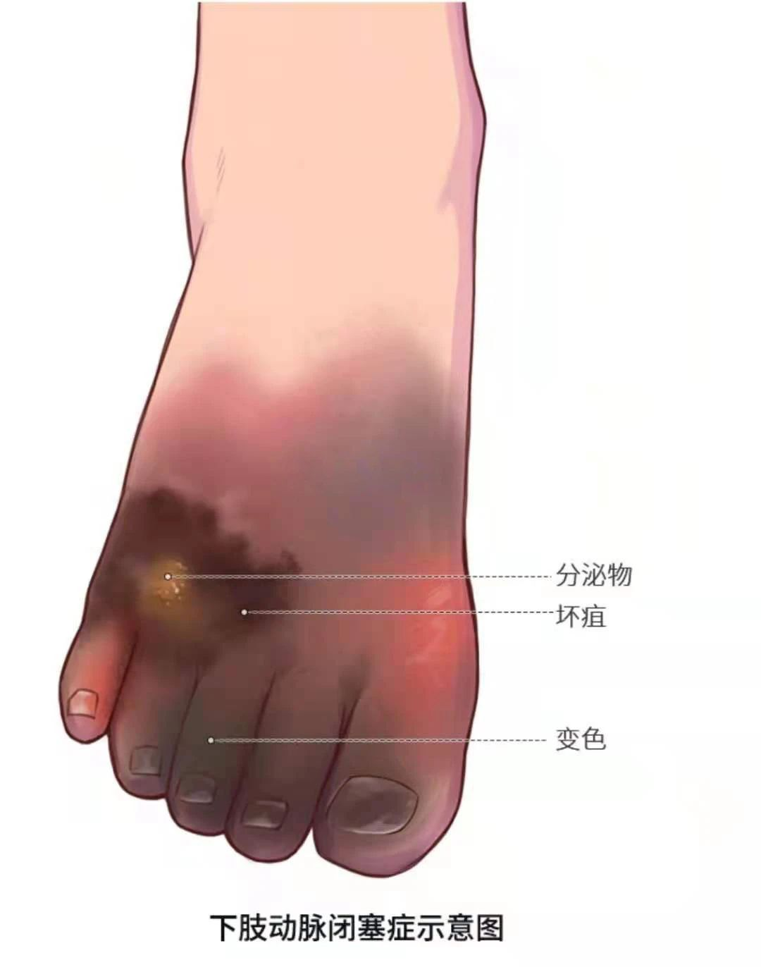 深靜脈血栓類似病癥的認識與區(qū)分