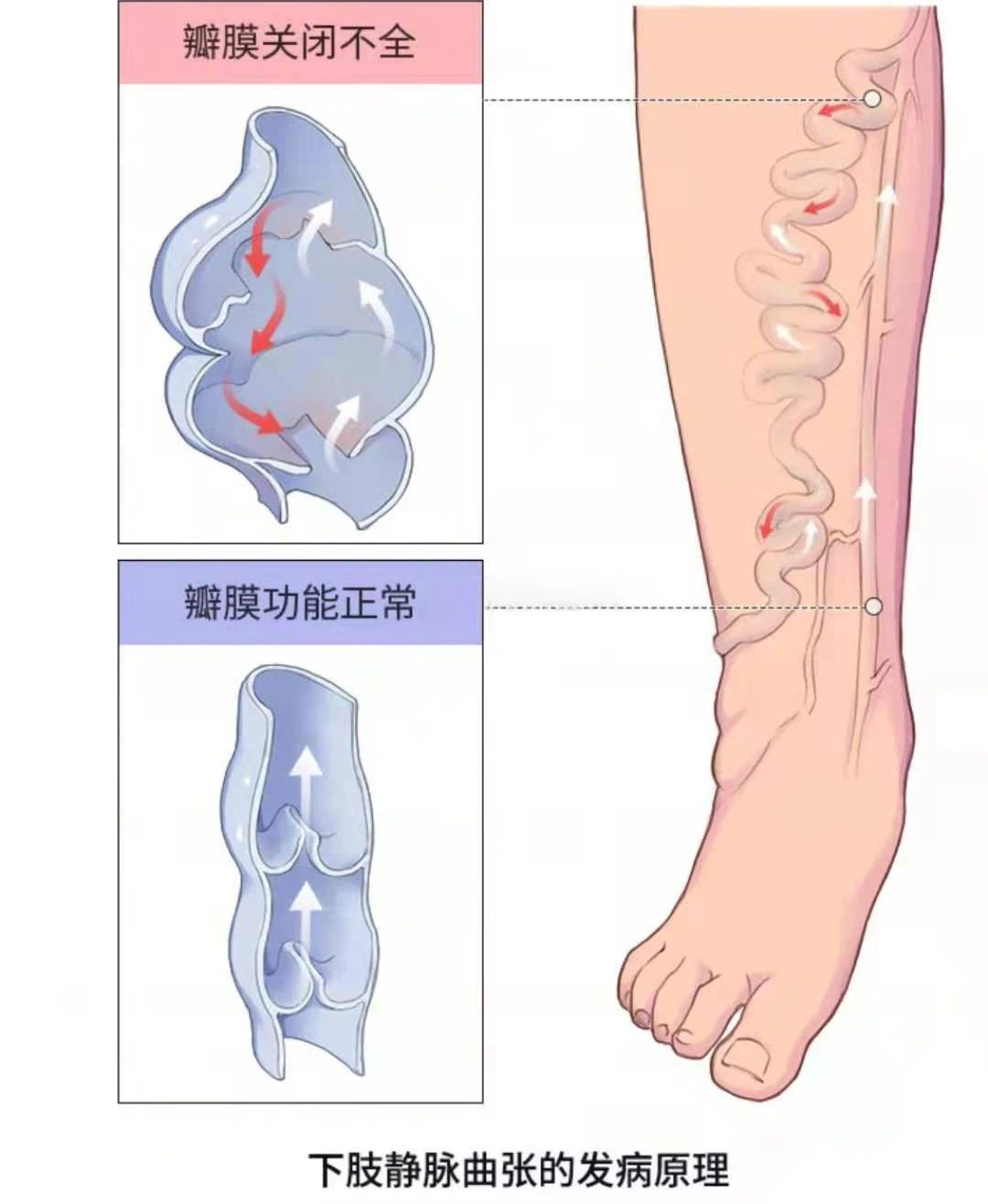 深靜脈血栓類似病癥的認識與區(qū)分