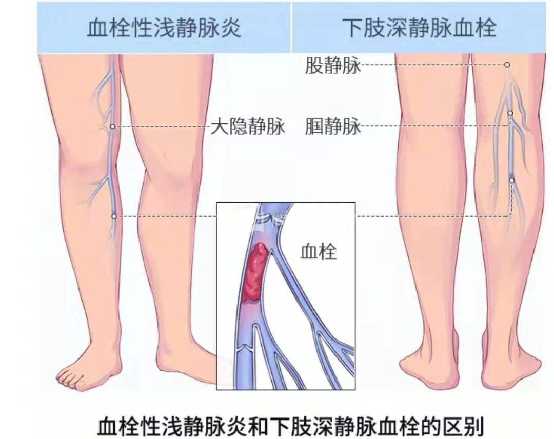 深靜脈血栓類似病癥的認識與區(qū)分