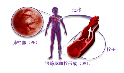骨科術(shù)后重點(diǎn)關(guān)注的問(wèn)題—VTE，該如何防治？