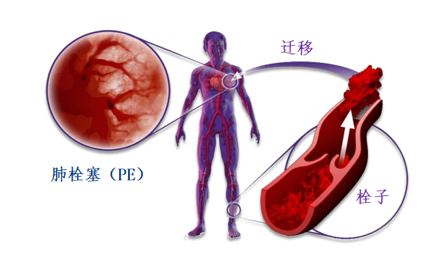動脈血栓和靜脈血栓有什么區(qū)別嗎？