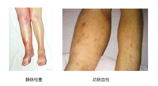 動脈血栓和靜脈血栓有什么區(qū)別嗎？