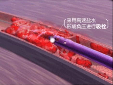 深靜脈血栓能致命，防治“大法”要了解！