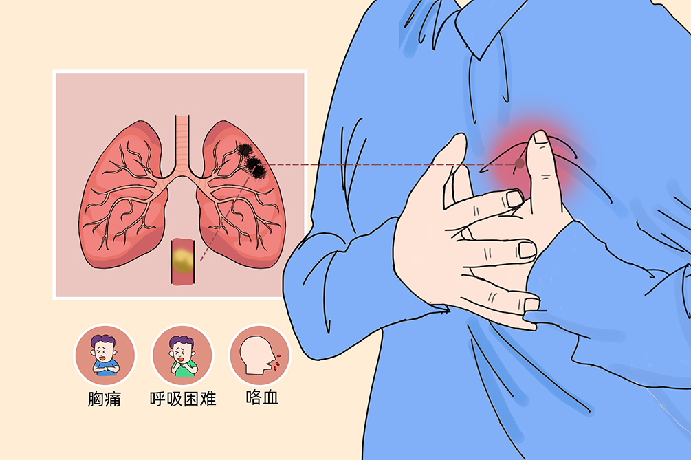 VTE的危害您了解嗎？