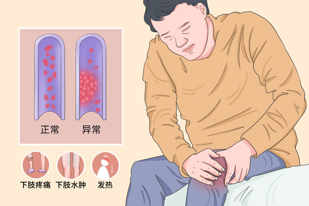 VTE的危害您了解嗎？