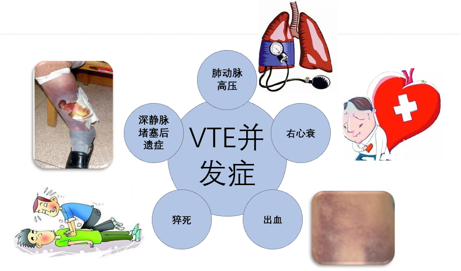 VTE的危害您了解嗎？